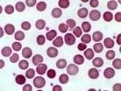 Platelet Rich Plasma Injections